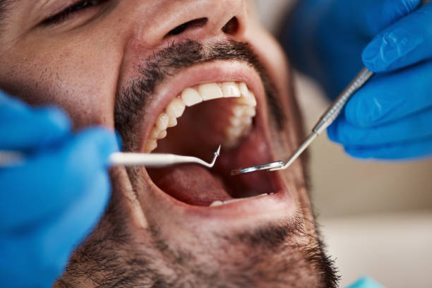 Best Emergency Treatment for Dental Infections or Abscesses in Mattoon, IL
